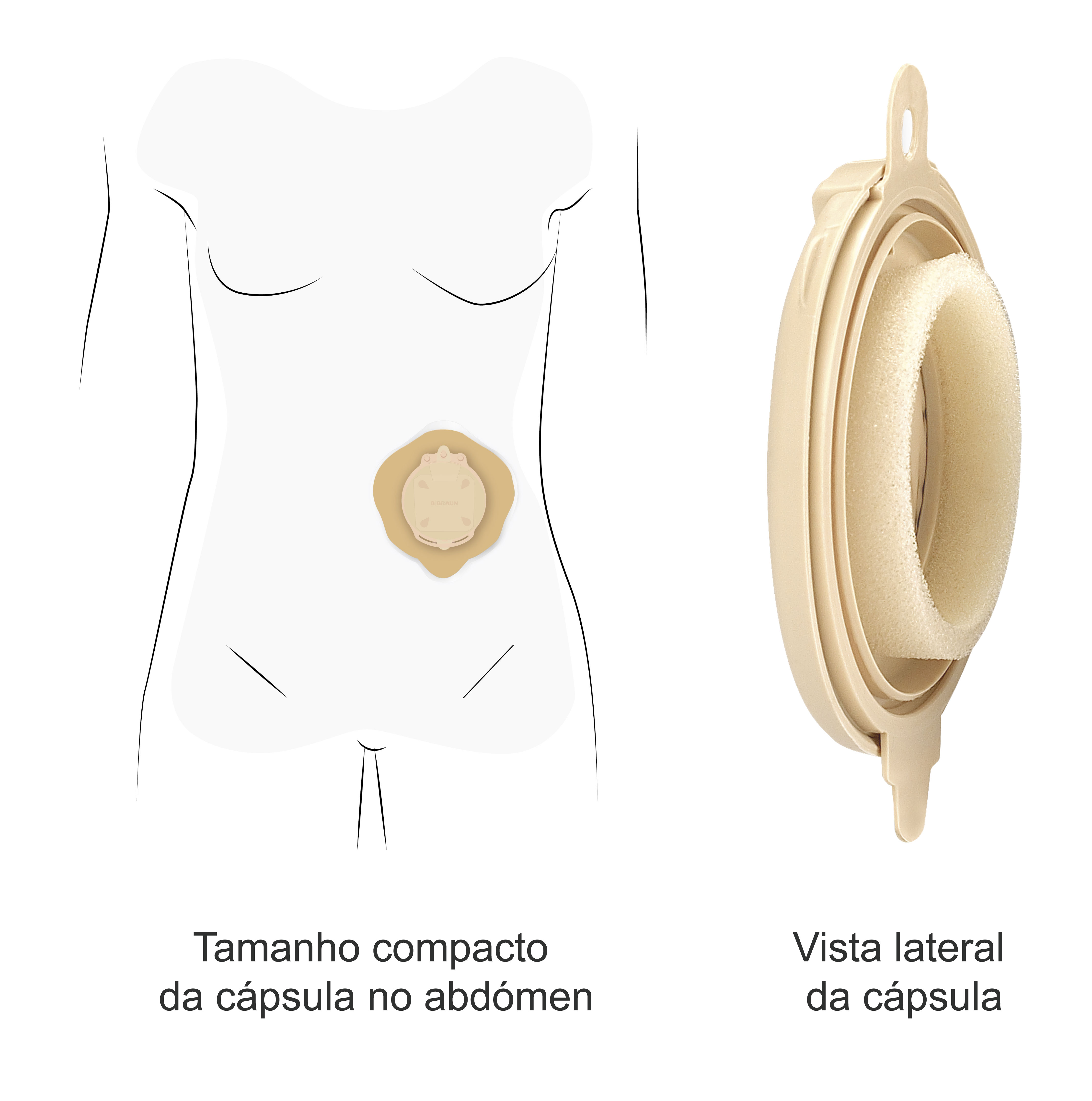 Cápsula inovadora devolve qualidade de vida a pessoas ostomizadas