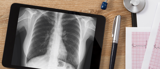 Futuro do diagnóstico das doenças intersticiais pulmonares com novidades