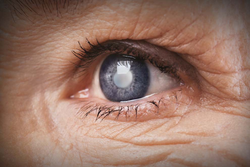 Perda de visão por glaucoma poderá ser evitada com aplicação de células estaminais do cordão umbilical, revela novo estudo